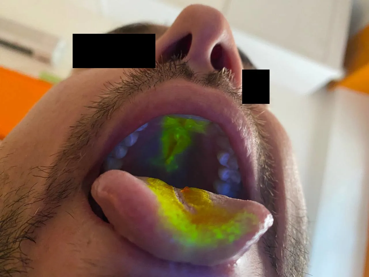 Deglutizione disfunzionale