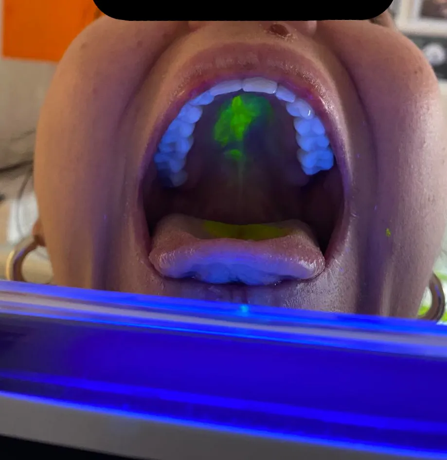 Immagine rappresentativa della deglutizione disfunzionale