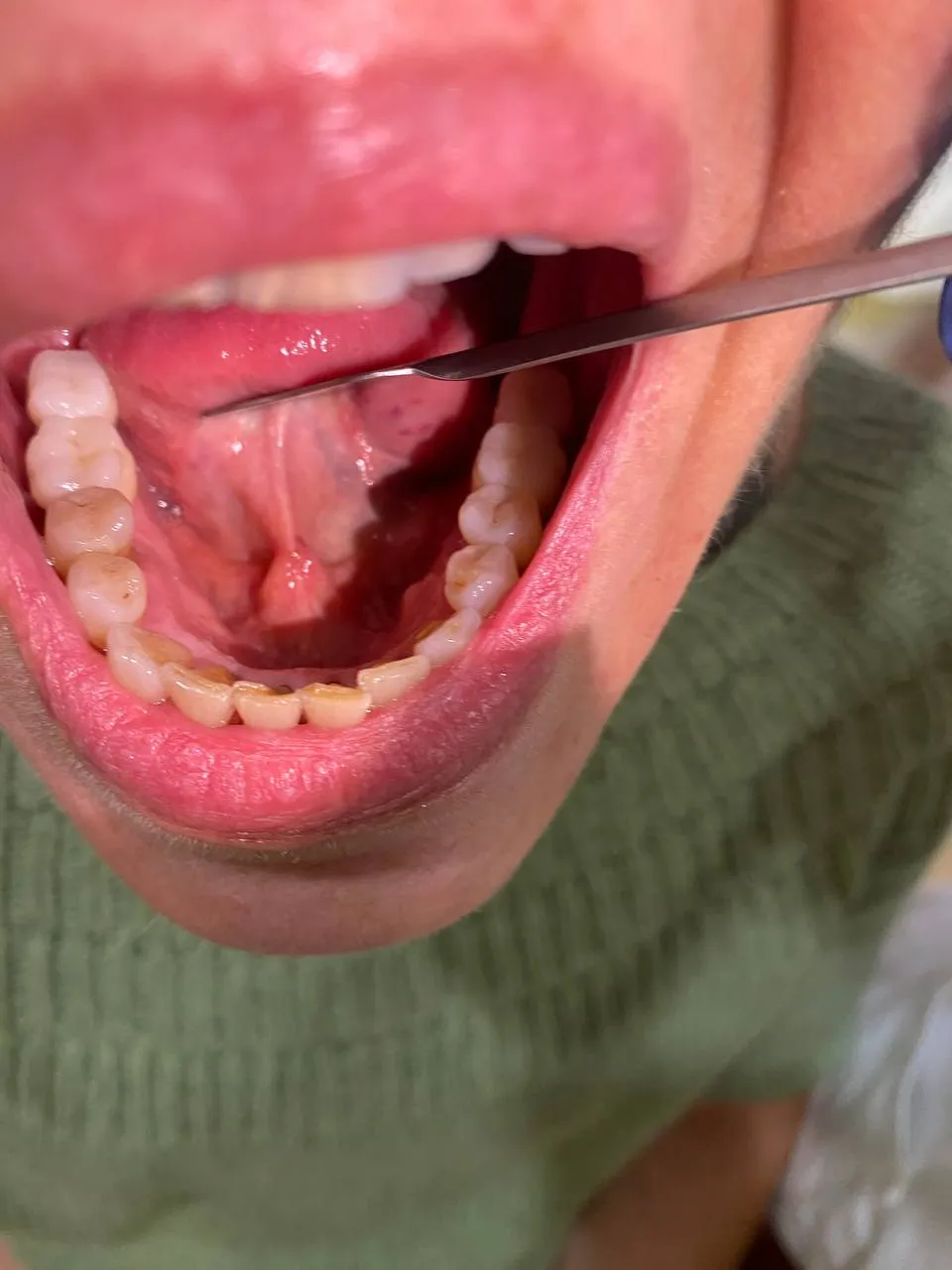 Frenulo Linguale Alterato