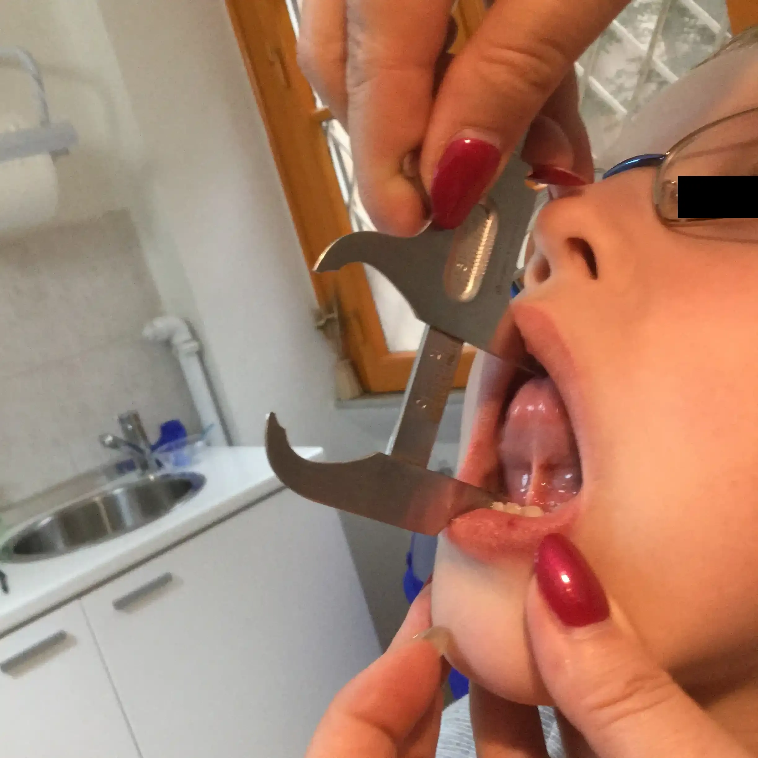 Immagine rappresentativa del frenulo linguale alterato