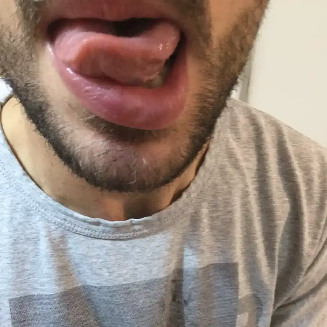 Immagine rappresentativa della paralisi del facciale